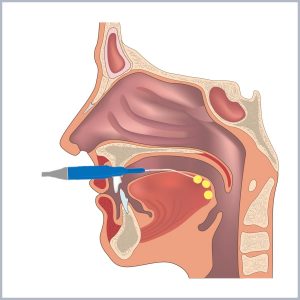 buton chirurgia limbii - dr ioan bulescu