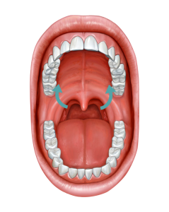 palatoplastie de expansiune - dr ioan bulescu